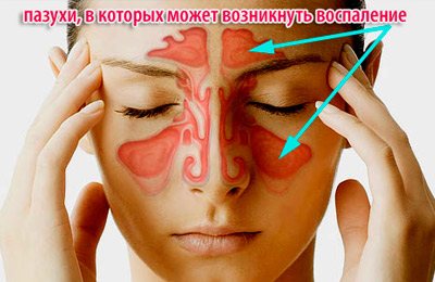 Места возникновения синусита