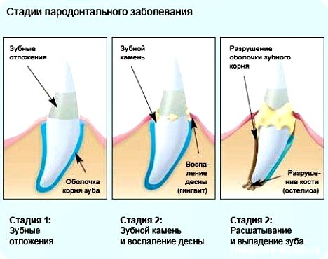последствия зубного камня